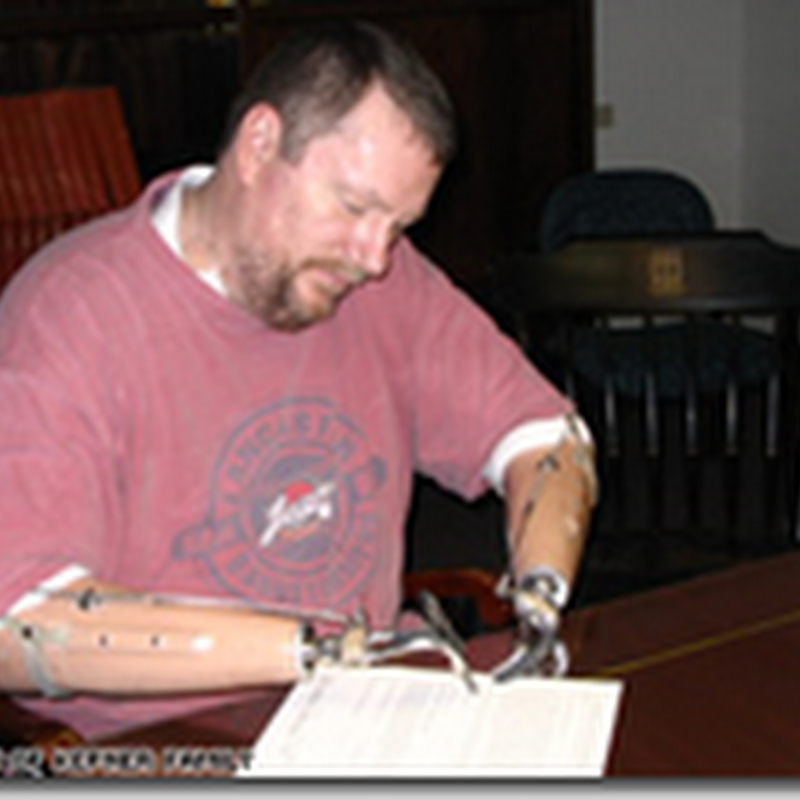 Pastry chef receives double hand transplant – Doing Well