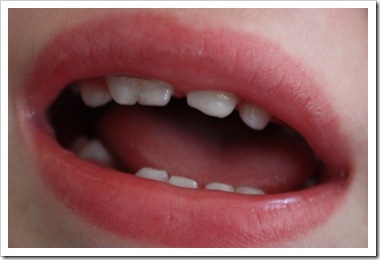 gemination - front tooth split into two teeth