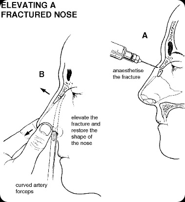 nose fracture