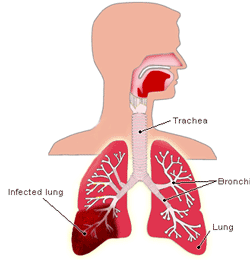 [pneumonia[17].gif]
