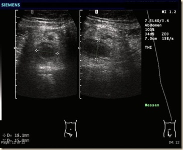 SonoAppendizitis SonoAppendizitis