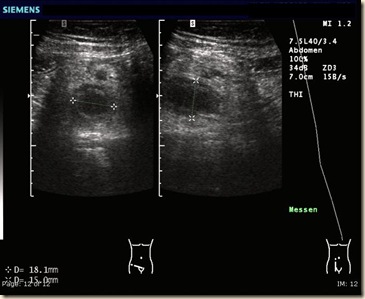 SonoAppendizitis