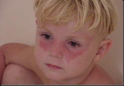 Jonas sunburned face