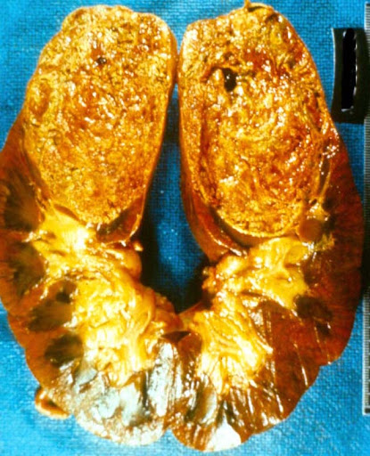 carcinoma
