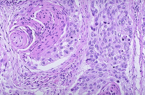 icd 9 squamous epith