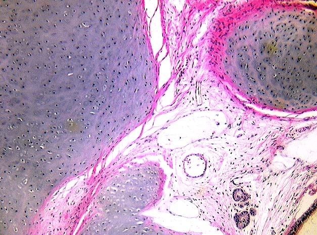 [fibroadipose[1].jpg]