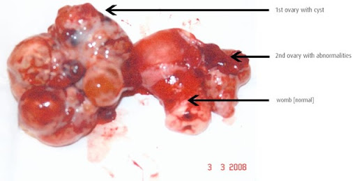 ovarian-cyst. The earlier the treatment, the more positive the long term ... ovarian-cyst. The earlier the treatment, the more positive the long term ...