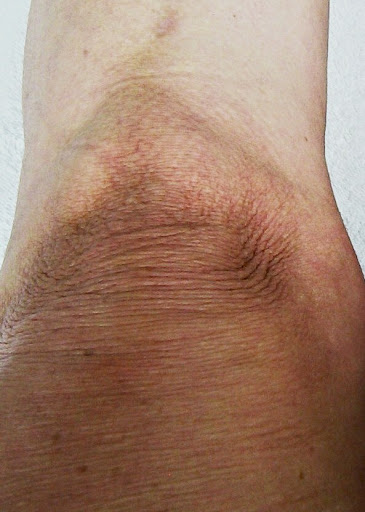 spider bite rash spreading. spider bite rashes. spider bite rash spreading.