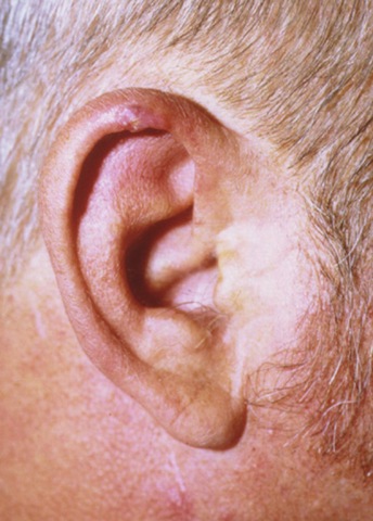 [chondrodermatitis nodularis[2].jpg]