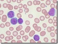chronic_lymphocytic_leukemia