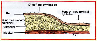 Fettsuging: Skjematisk tverrrsnitt gjennom hud, underhud og muskel.