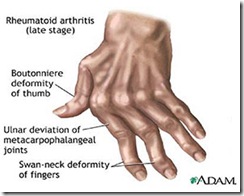 rheumatoid_arthritis_pic