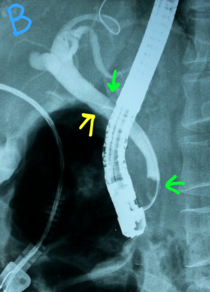ERCP & EGD CBD stone removal pre cholecystectomy
