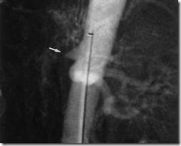 intstinal ischemia angiographic view