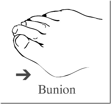 bunion