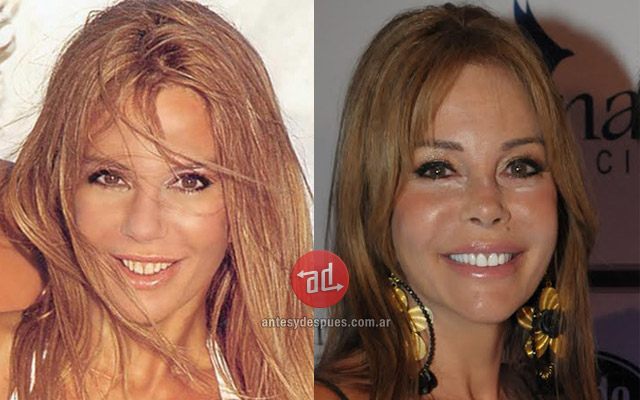 Lip augmentation of Graciela Alfano