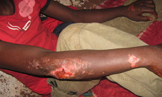 Un Congolais en instance d'expulsion blessé et trainé sur un engin dans la ville angolaise de Dundo (Ph. archives, Site Kamako)