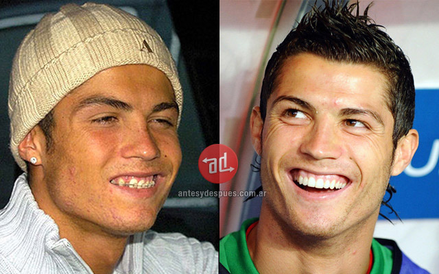 Los nuevos dientes de Cristiano Ronaldo