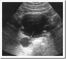 Ultrasound images of Acute pyelonephritis - Radiology Imaging