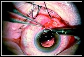 Eye.Surgery