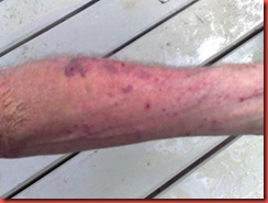 arm with eczema