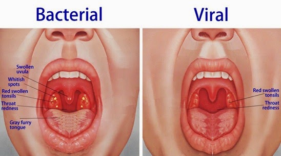 tonsillitis home remedies