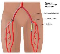 femoral artery