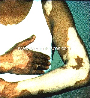 vitiligo (pernic anemia, addisons, DM, hypothyr)