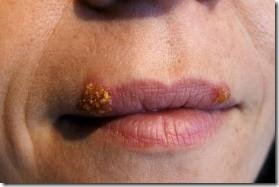 small multiple blisters around lips herpes labialis