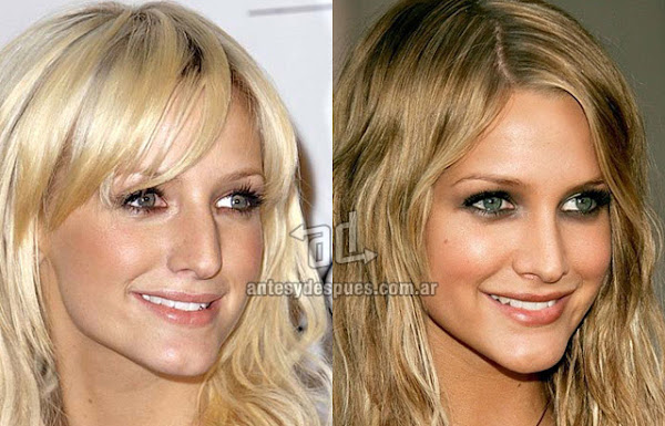 Nose Job, Rhinoplasty, Ashlee Simpson