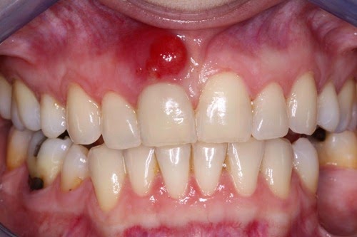home remedies for abcessed tooth_1