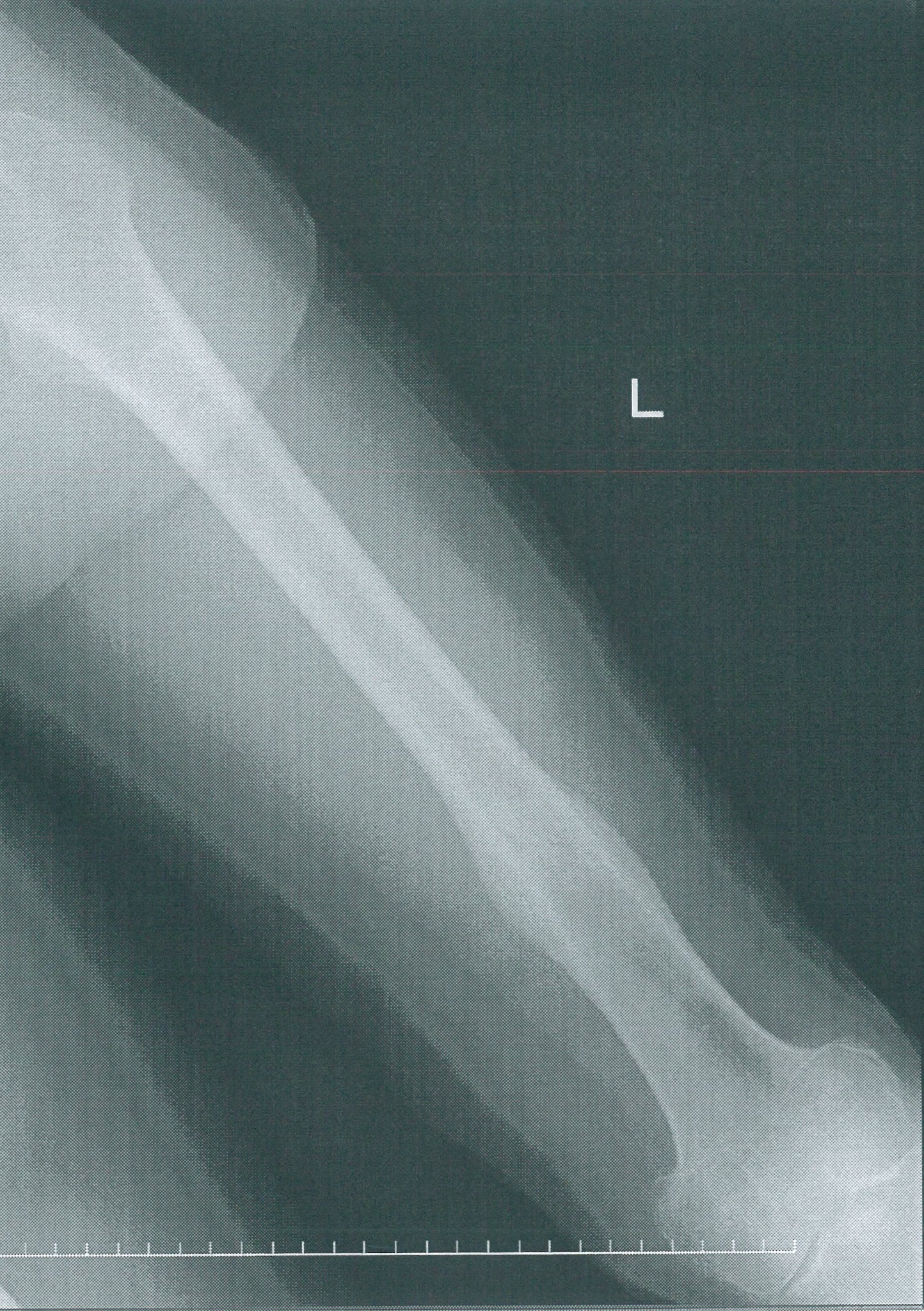 左大腿骨骨幹部骨折日記 1月14日 トルベ コムラード