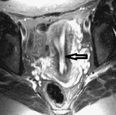 MRI Imaging of Septate Uterus - Radiology Imaging