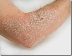 psoriasis como se ve y curar de la piel
