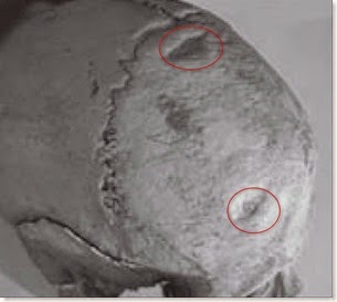 Cova d´En Pardo - Cráneo con muestras de agresión con arma