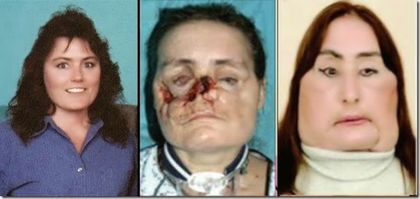 connie culp fotos transplante cara (3)