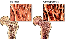 la osteoporosis