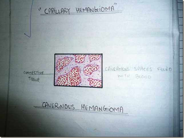 cavernous hemangioma diagram -histopathology