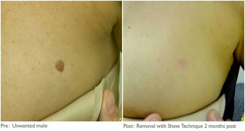 home remedies for mole removal_4