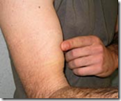 Roturas del tendón distal del bíceps braquial