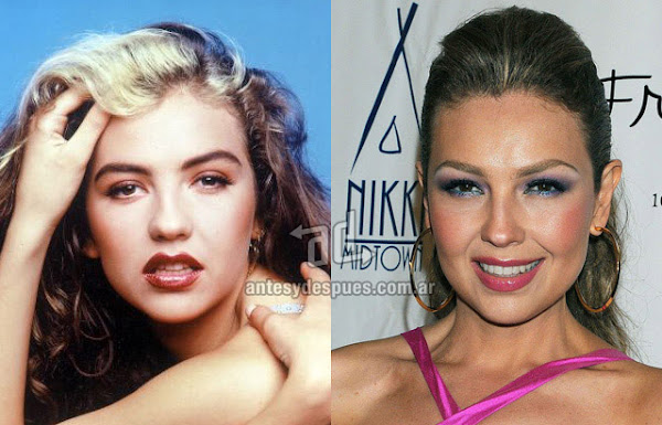 Nose Job, Rhinoplasty, Thalia