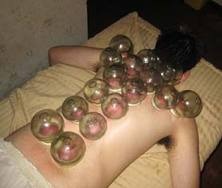 [cupping-what%2520is%2520cupping-hijama-benefits%255B3%255D.jpg]