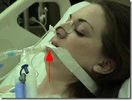 mechanical ventilation with endotracheal tube