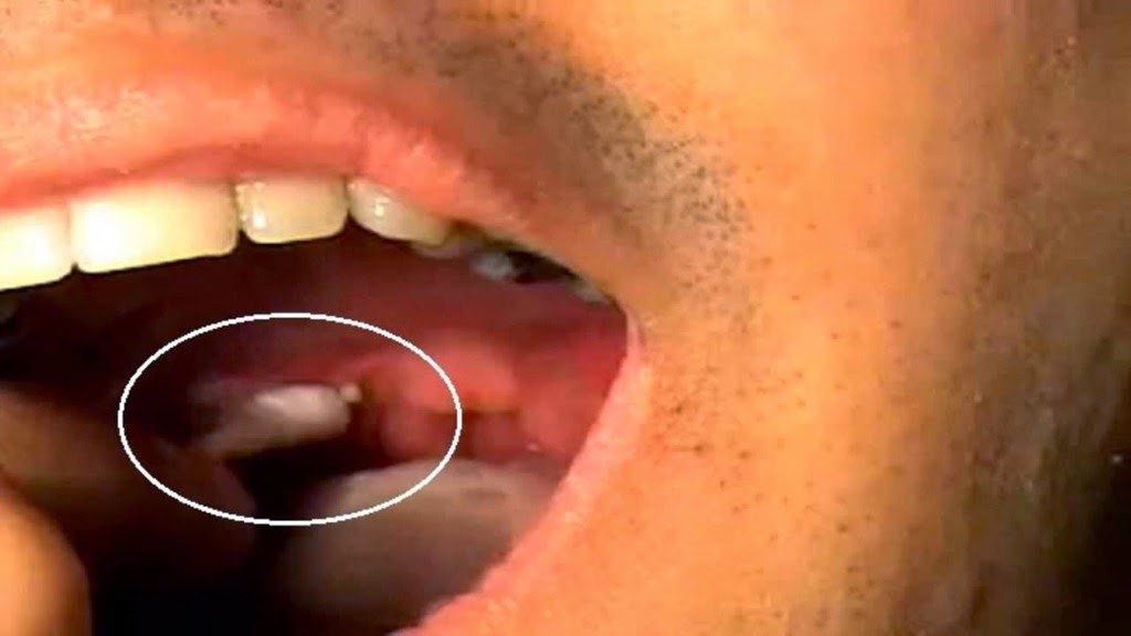 [home-remedies-for-tonsil-stones_24.jpg]