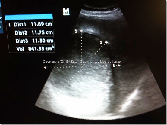 Dr siddique akbar sati, ultrasonic view of liver abscess 