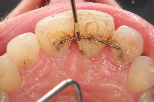 home remedies for abcessed tooth_4