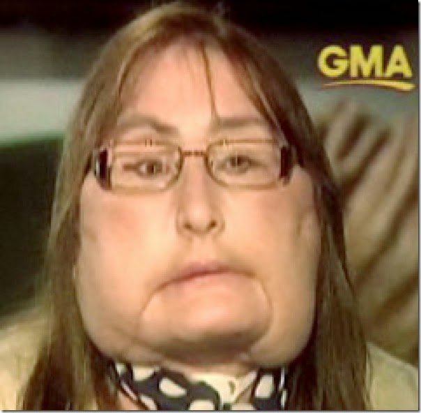 connie culp fotos transplante cara (7)