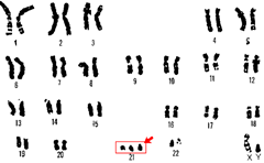 down syndrome karyotype