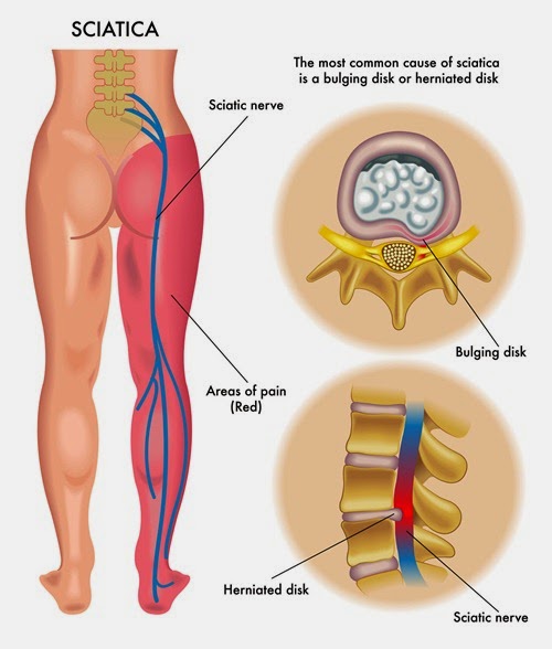 home remedies for sciatic nerve pain_2