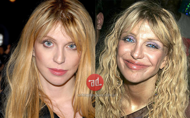 Lip augmentation of Courtney Love